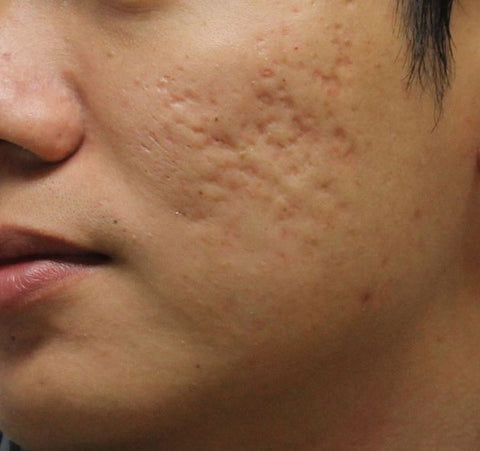 Get rid of deep acne scarring